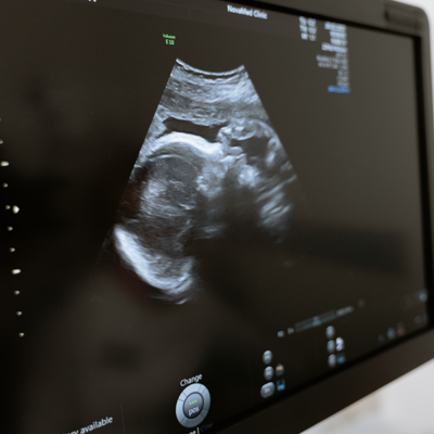 an ultrasound of a fetus in early development